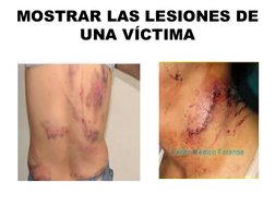 MOSTRAR LAS LESIONES DE 
UNA VÍCTIMA 
