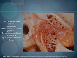 La ATM Relaciona el 
cóndilo  
mandibular 
con el cóndilo y la cavidad  
glenoidea 
del temporal, mediante  
un disco de 
t