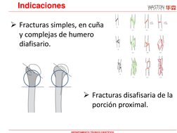 Indicaciones
Fracturas simples, en cuña 
y complejas de humero 
diafisario.
Fracturas disafisaria de la 
porción proximal.
