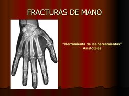 FRACTURAS DE MANO
FRACTURAS DE MANO
“Herramienta de las herramientas”
Aristóteles
