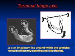 It is an imaginary line around which the condyles 
 rotate during early opening and late closing.
