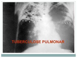 TUBERCULOSE PULMONAR
