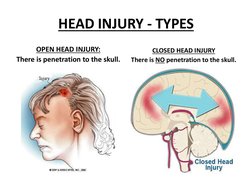 Skull Potential Injuries Head Injury: Types and Management | PDF | Traumatic Brain Injury | Injury