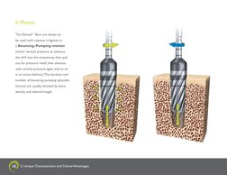 10
II. Motion 
The Densah™ Burs are always to  
be used with copious irrigation in  
a Bouncing-Pumping motion 
(minor vertic