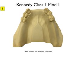 RPD Design Cases and Classifications | PDF | Science & Mathematics