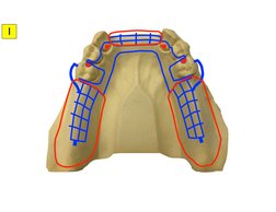 RPD Design Cases and Classifications | PDF | Science & Mathematics
