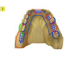 Rpd Design Case Examples RPD Design Cases and Classifications | PDF | Science & Mathematics