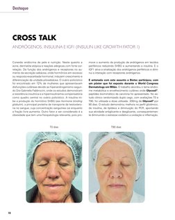 10
Destaque
CROSS TALK
ANDRÓGENOS, INSULINA E IGF1 (INSULIN LIKE GROWTH FATOR 1)
Conexão endócrina da pele e nutrição. Neste