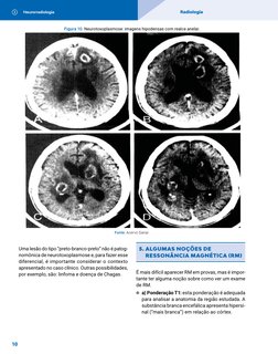 Neurorradiologia
Radiologia
10
Figura 10. Neurotoxoplasmose: imagens hipodensas com realce anelar.
Fonte: Acervo Sanar.
Uma l