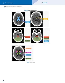 Neurorradiologia
Radiologia
4
Dica 2: Principais marcos anatômicos.
Figura 2. Marcos anatômicos.
Fonte: Acervo Sanar.
