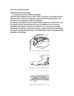 Técnica de Gastrostomía
Gastrostomías temporarias 
a) Gastrostomía de Witzel (temporal). 
Descrita por primera vez en el año