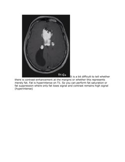 It is a bit difficult to tell whether
there is contrast-enhancement at the margins or whether this represents 
merely fat. Fa