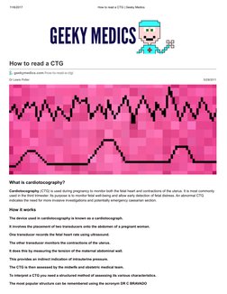Nice Ctg Interpretation Guide.pdf CTG Reading Guide for Pregnancy | PDF | Heart Rate | Fetus