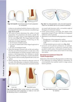 282
Textbook of Operative Dentistry
on sound tooth structure with a cavosurface angle of
90 degrees for butt joint relation.