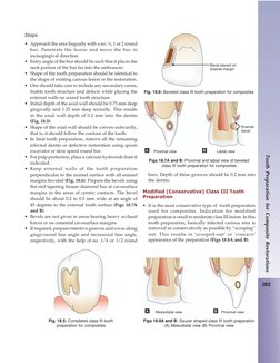 283
Tooth Preparation for Composite Restorations
Steps
• Approach the area lingually with a no. ½, 1 or 2 round
bur. Penetrat