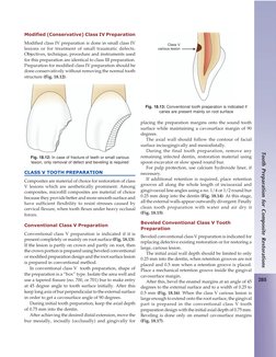 285
Tooth Preparation for Composite Restorations
Modified (Conservative) Class IV Preparation
Modified class IV preparation i
