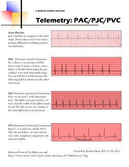 5 MINUTE SPEEDY SESSION 
Telemetry: PAC/PJC/PVC 
Sinus Rhythm: 
Just a baseline to compare to the other 
strips. Notice that