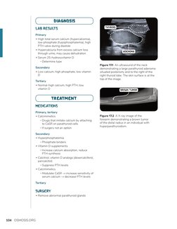 104
OSMOSIS.ORG
LAB RESULTS
Primary
 ▪High total serum calcium (hypercalcemia), 
low phosphate (hypophosphatemia), high 
PTH