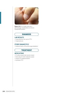 106
OSMOSIS.ORG
Figure 17.3  Dry, brittle nails are a 
dermatologic manifestation of chronic 
hypoparathyroidism.
MEDICATIONS