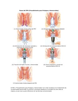 Pasos del PPH (Procedimiento para Prolapso y Hemorroides) 
 
  
(1) Hemorroides mixtas antes del PPH 
  
(2) Introducción del