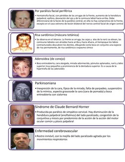 Por parálisis facial periférica
• Hemiatrofia facial, con pérdidas de las arrugas de la frente, aumento de la hendidura 
palp
