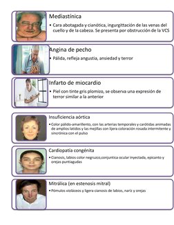 Mediastínica
• Cara abotagada y cianótica, ingurgittación de las venas del 
cuello y de la cabeza. Se presenta por obstruc