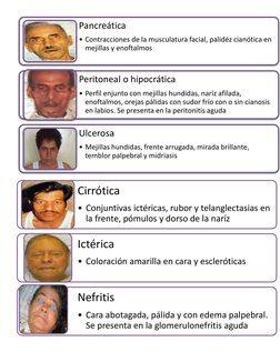 Pancreática
• Contracciones de la musculatura facial, palidéz cianótica en 
mejillas y enoftalmos
Peritoneal o hipocrática