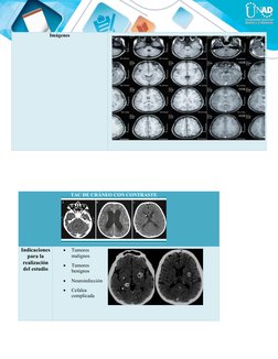 Imágenes
TAC DE CRÁNEO CON CONTRASTE
Indicaciones
para la
realización
del estudio

Tumores
malignos 

Tumores
benignos

Ne