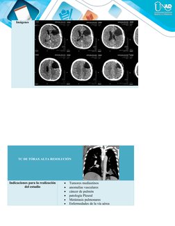 Imágenes
TC DE TÓRAX ALTA RESOLUCIÓN 
Indicaciones para la realización
del estudio

Tumores mediastinos 

anomalías vascula