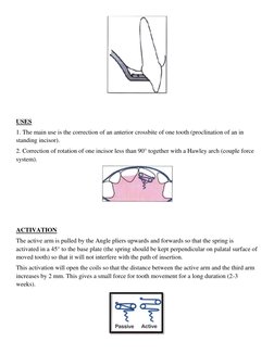 Z-Spring Orthodontic Appliance Overview | PDF | Soldering | Solder