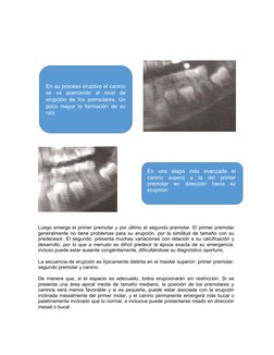 Luego emerge el primer premolar y por último el segundo premolar. El primer premolar
generalmente no tiene problemas para su