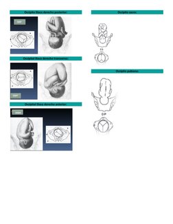 Occipito Iliaco derecho posterior: 
 
Occipital iliaco derecho transverso: 
 
Occipital iliaco derecho anterior: