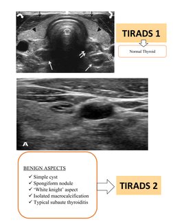 BENIGN ASPECTS
Simple cyst
Spongiform nodule
‘White knight’ aspect
Isolated macrocalcification
Typical subaute thyroidit