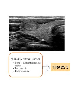 PROBABLY BINAGN ASPECT
None of the hight suspicious
aspect 
Isoechogenic
Hyperechogenic
TIRADS 3

