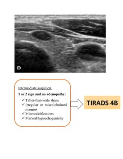 Intermediate suspicion 
1 or 2 sign and no adenopathy:
Taller-than-wide shape
Irregular or microlobulated
margins
Microcal
