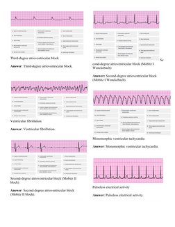 Third-degree atrioventricular block
Answer: Third-degree atrioventricular block.
Ventricular fibrillation
Answer: Ventricular