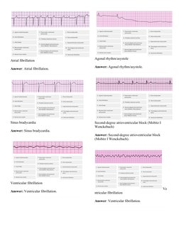 Atrial fibrillation
Answer: Atrial fibrillation.
Sinus bradycardia
Answer: Sinus bradycardia.
Ventricular fibrillation
Answer