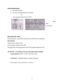 Class III malocclusion
          L - 20º torque brackets
          U - 10º reverse torque bracket (U1-Sn>100º)