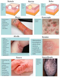 Bolha 
Pústula 
Vesícula 
Atroﬁa 
Exuceração  
Úlcera  
Escama  
Fissura 
Liqueniﬁcação 
