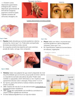 Lesões elementares primárias sólidas 
•
Pápulas: lesão elevada que acomete epiderme e derme, 
circunscrita, menor que 1 cm. P