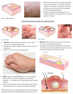 •
OBS: Urticária, também chamada de pápula 
ou placa urticariana —> elevação de forma 
irregular, cor variável do róseo ao ve