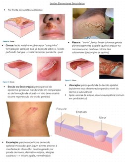 Lesões Elementares Secundarias 
•
Por Perda de substância (tecido):
•
Crosta: lesão inicial é recoberta por “casquinha” 
form