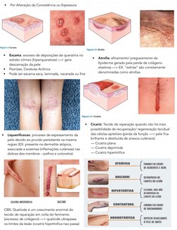 •
Por Alteração da Consistência ou Espessura:  
•
Escama: excesso de deposições de queratina no 
estrato córneo (hiperquerato