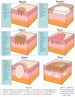 Mácula 
Mancha 
Pápula  
Placa  
Placa  
Nódulo
MACETE: 
•
Mácula/ Mancha = “mancha de roupa” —> sem relevo e com alteração d