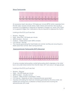 Sinus Tachycardia
An excessive heart rate above 100 beats per minute (BPM) which originates from
the SA node. Causes include
