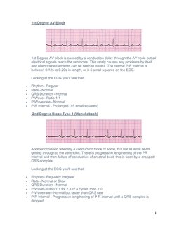 1st Degree AV Block
1st Degree AV block is caused by a conduction delay through the AV node but all
electrical signals reach