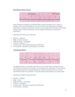 2nd Degree Block Type 2
When electrical excitation sometimes fails to pass through the A-V node or 
bundle of His, this inter