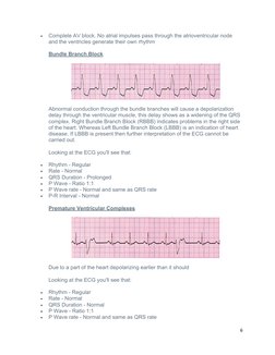 
Complete AV block. No atrial impulses pass through the atrioventricular node 
and the ventricles generate their own rhythm