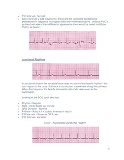
P-R Interval - Normal

Also you'll see 2 odd waveforms, these are the ventricles depolarising 
prematurely in response to
