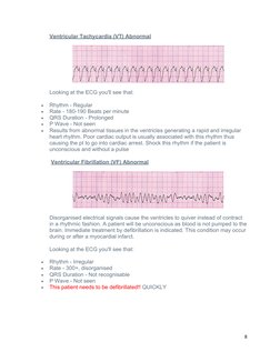 Ventricular Tachycardia (VT) Abnormal
Looking at the ECG you'll see that:

Rhythm - Regular

Rate - 180-190 Beats per minut